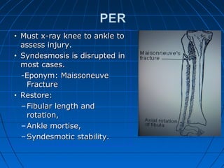 • Must x-ray knee to ankle toMust x-ray knee to ankle to
assess injury.assess injury.
• Syndesmosis is disrupted inSyndesmosis is disrupted in
most cases.most cases.
-Eponym: Maissoneuve-Eponym: Maissoneuve
FractureFracture
• Restore:Restore:
– Fibular length andFibular length and
rotation,rotation,
– Ankle mortise,Ankle mortise,
– Syndesmotic stability.Syndesmotic stability.
 