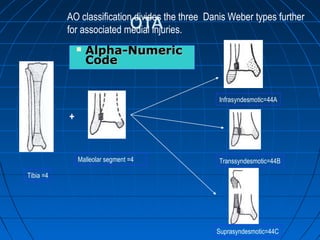  Alpha-NumericAlpha-Numeric
CodeCode
Tibia =4
Malleolar segment =4
Infrasyndesmotic=44A
Suprasyndesmotic=44C
Transsyndesmotic=44B
+
AO classification divides the three Danis Weber types further
for associated medial injuries.
 