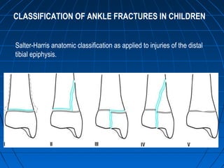CLASSIFICATION OF ANKLE FRACTURES IN CHILDREN
Salter-Harris anatomic classification as applied to injuries of the distal
tibial epiphysis.
 