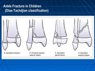 Ankle Fracture in Children
(Dias-Tachdjian classification)
 