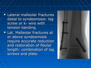  Lateral malleolar fracturesLateral malleolar fractures
distal to syndesmosis: lagdistal to syndesmosis: lag
screw or k- wire withscrew or k- wire with
tension banding.tension banding.
 Lat. Malleolar fractures atLat. Malleolar fractures at
or above syndesmosisor above syndesmosis
require accurate reductionrequire accurate reduction
and restoration of fibularand restoration of fibular
length: combination of laglength: combination of lag
screws and plate.screws and plate.
 