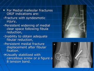  For Medial malleolar fracturesFor Medial malleolar fractures
ORIF indications are:ORIF indications are:
-Fracture with syndesmotic-Fracture with syndesmotic
injury,injury,
-Persistent widening of medial-Persistent widening of medial
clear space following fibulaclear space following fibula
reduction,reduction,
-Inability to obtain adequate-Inability to obtain adequate
fibular reduction,fibular reduction,
-Persistent medial fracture-Persistent medial fracture
displacement after fibulardisplacement after fibular
fixation.fixation.
Usually stabilized withUsually stabilized with
cancellous screw or a figure ofcancellous screw or a figure of
8 tension band.8 tension band.
 