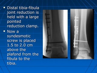  Distal tibia-fibulaDistal tibia-fibula
joint reduction isjoint reduction is
held with a largeheld with a large
pointedpointed
reduction clamp.reduction clamp.
 Now aNow a
syndesmoticsyndesmotic
screw is placedscrew is placed
1.5 to 2.0 cm1.5 to 2.0 cm
above theabove the
plafond from theplafond from the
fibula to thefibula to the
tibia.tibia.
 