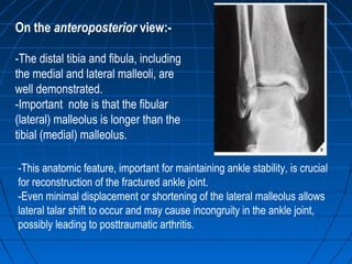On the anteroposterior view:-
-The distal tibia and fibula, including
the medial and lateral malleoli, are
well demonstrated.
-Important note is that the fibular
(lateral) malleolus is longer than the
tibial (medial) malleolus.
-This anatomic feature, important for maintaining ankle stability, is crucial
for reconstruction of the fractured ankle joint.
-Even minimal displacement or shortening of the lateral malleolus allows
lateral talar shift to occur and may cause incongruity in the ankle joint,
possibly leading to posttraumatic arthritis.
 