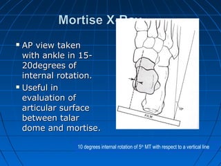 AP view takenAP view taken
with ankle in 15-with ankle in 15-
20degrees of20degrees of
internal rotation.internal rotation.
 Useful inUseful in
evaluation ofevaluation of
articular surfacearticular surface
between talarbetween talar
dome and mortise.dome and mortise.
10 degrees internal rotation of 5th
MT with respect to a vertical line
 