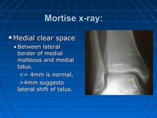  Medial clear spaceMedial clear space
• Between lateralBetween lateral
border of medialborder of medial
malleous and medialmalleous and medial
talus.talus.
<= 4mm is normal,<= 4mm is normal,
>4mm suggests>4mm suggests
lateral shift of talus.lateral shift of talus.
 