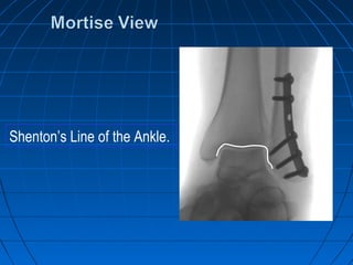 Shenton’s Line of the Ankle.
 