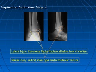 Supination Adduction: Stage 2Supination Adduction: Stage 2
Lateral Injury: transverse fibular fracture at/below level of mortise
Medial injury: vertical shear type medial malleolar fracture
 