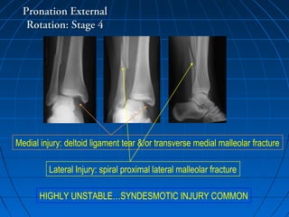 Pronation ExternalPronation External
Rotation: Stage 4Rotation: Stage 4
Medial injury: deltoid ligament tear &/or transverse medial malleolar fracture
Lateral Injury: spiral proximal lateral malleolar fracture
HIGHLY UNSTABLE…SYNDESMOTIC INJURY COMMON
 