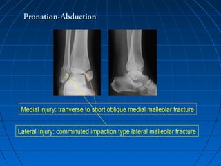 Pronation-AbductionPronation-Abduction
Medial injury: tranverse to short oblique medial malleolar fracture
Lateral Injury: comminuted impaction type lateral malleolar fracture
 