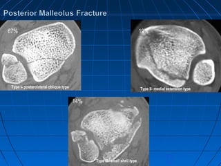 Type I- posterolateral oblique type Type II- medial extension type
Type III- small shell type
67% 19%
14%
 