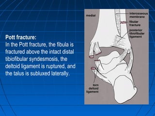 Pott fracture:
In the Pott fracture, the fibula is
fractured above the intact distal
tibiofibular syndesmosis, the
deltoid ligament is ruptured, and
the talus is subluxed laterally.
 