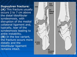 Dupuytren fracture:
(A) This fracture usually
occurs 2 to 7 cm above
the distal tibiofibular
syndesmosis, with
disruption of the medial
collateral ligament and,
typically, tear of the
syndesmosis leading to
ankle instability.
(B) In the low variant,
the fracture occurs more
distally and the
tibiofibular ligament
remains intact.
 