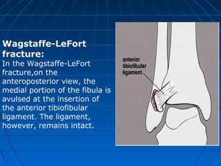 Wagstaffe-LeFort
fracture:
In the Wagstaffe-LeFort
fracture,on the
anteroposterior view, the
medial portion of the fibula is
avulsed at the insertion of
the anterior tibiofibular
ligament. The ligament,
however, remains intact.
 