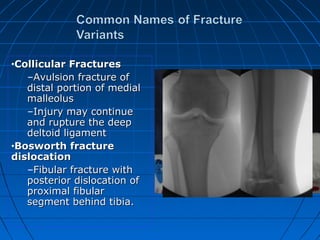•Collicular FracturesCollicular Fractures
–Avulsion fracture ofAvulsion fracture of
distal portion of medialdistal portion of medial
malleolusmalleolus
–Injury may continueInjury may continue
and rupture the deepand rupture the deep
deltoid ligamentdeltoid ligament
•Bosworth fractureBosworth fracture
dislocationdislocation
–Fibular fracture withFibular fracture with
posterior dislocation ofposterior dislocation of
proximal fibularproximal fibular
segment behind tibia.segment behind tibia.
POSTERIOR COLLICULUS ANTERIOR COLLICULUS
INTERCOLLICULAR GROOVE
 