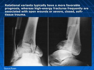 Source:Rosen
Rotational variants typically have a more favorable
prognosis, whereas high-energy fractures frequently are
associated with open wounds or severe, closed, soft-
tissue trauma.
 