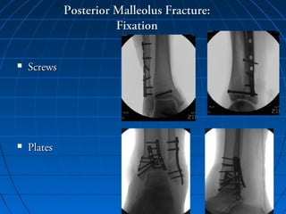 Posterior Malleolus Fracture:Posterior Malleolus Fracture:
FixationFixation
 ScrewsScrews
 PlatesPlates
 