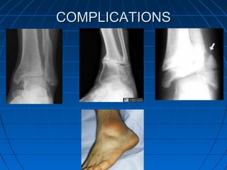 COMPLICATIONSCOMPLICATIONS
 