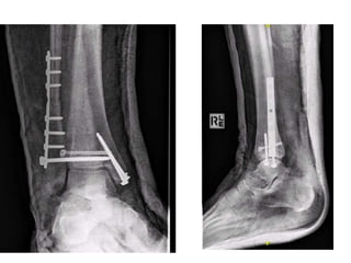 Ankle fractures and dislocations | PPTX