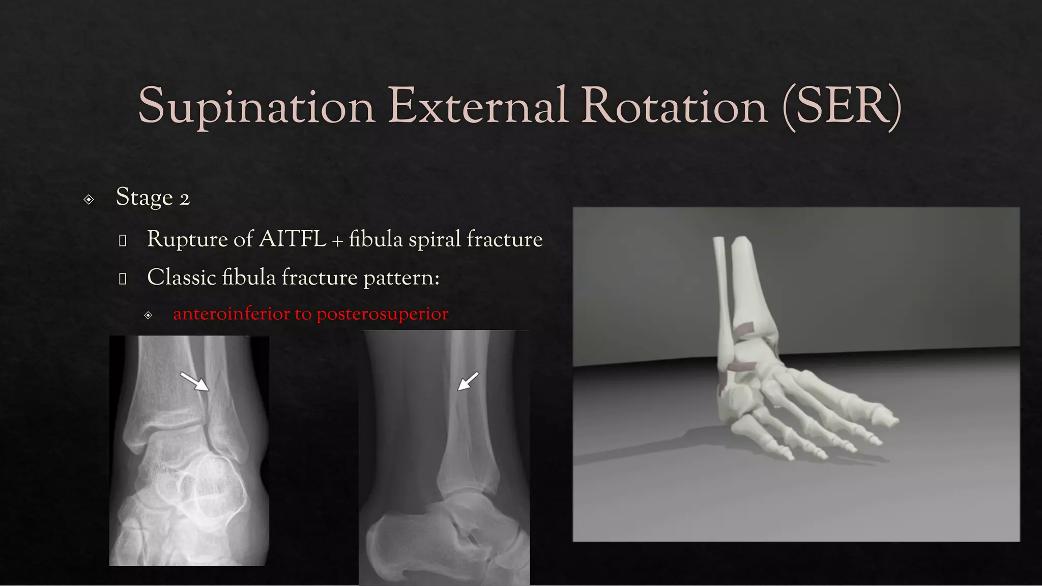ANKLE FRACTURES.pdf