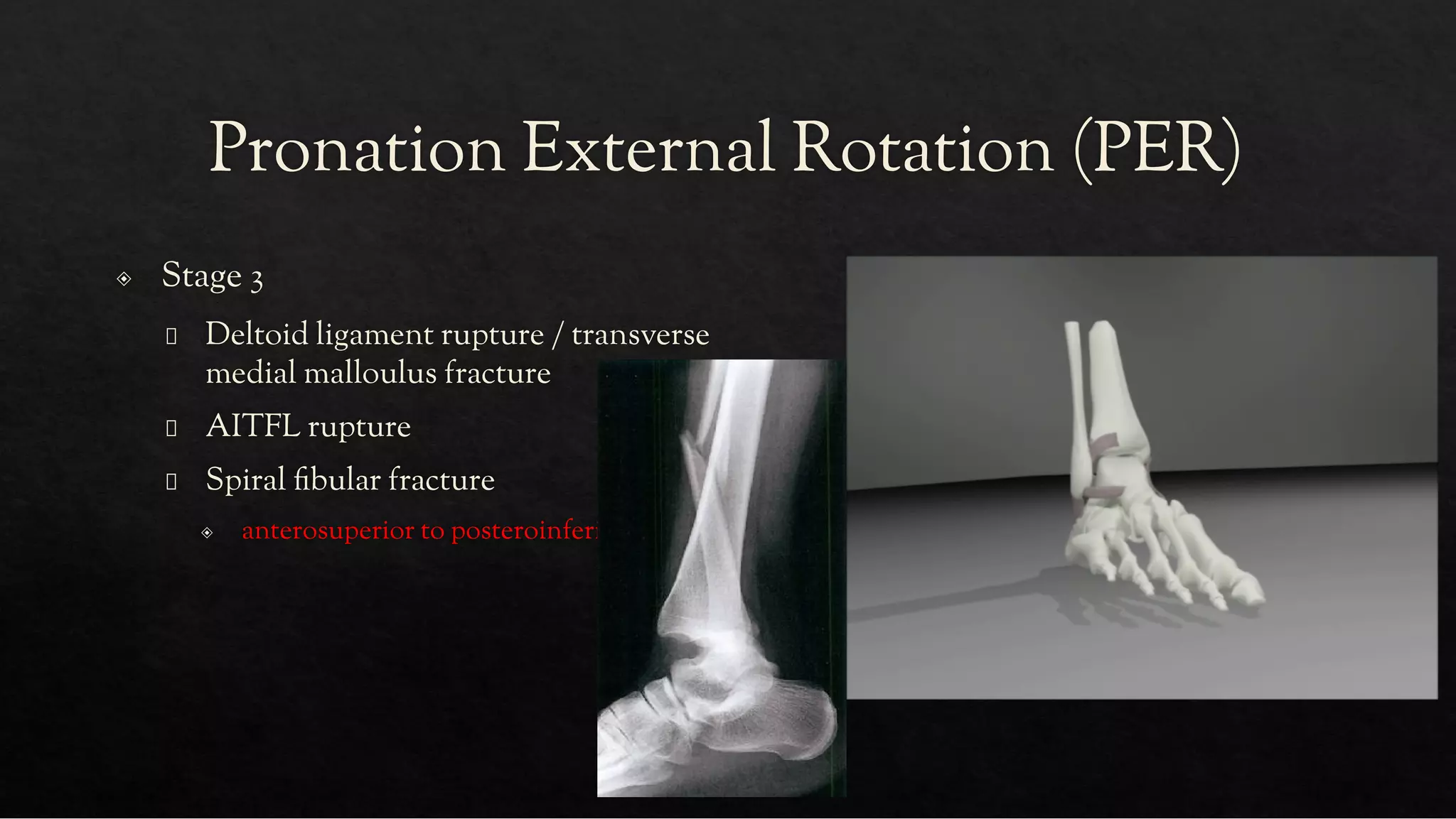 ANKLE FRACTURES.pdf