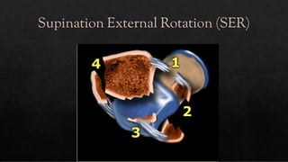 Supinated External Rotation ANKLE FRACTURES.pdf