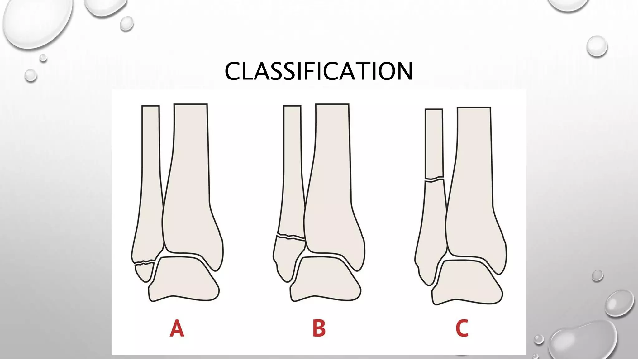 Ankle fractures.pptx