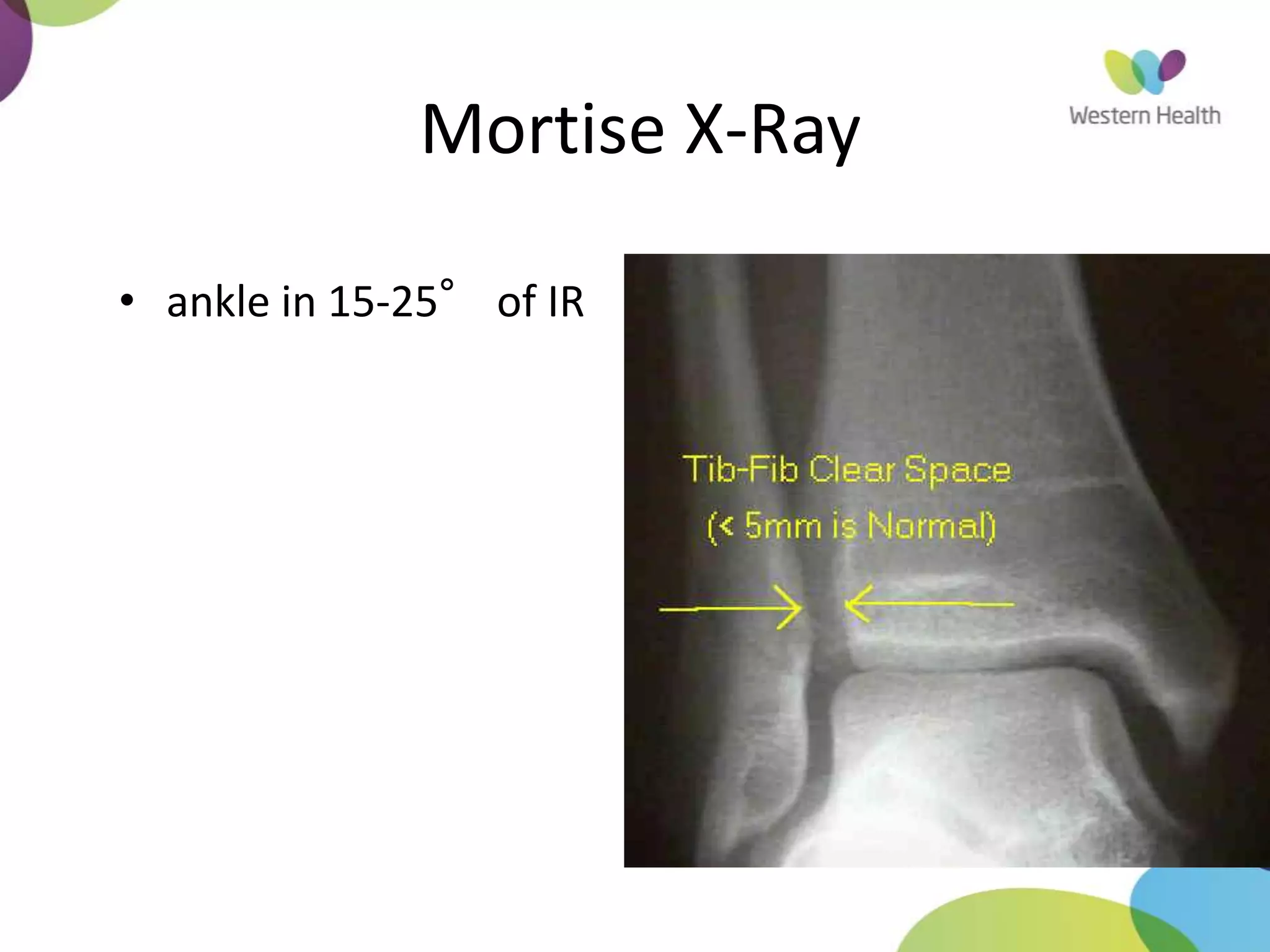 Mortise X-Ray
• ankle in 15-25° of IR
 