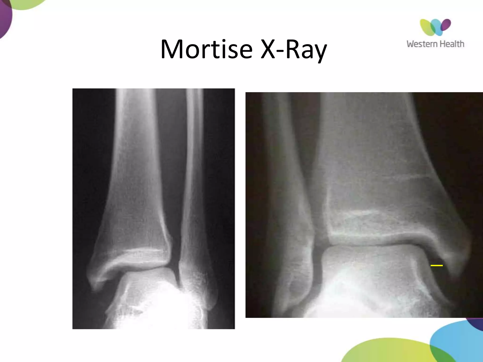 Mortise X-Ray
 