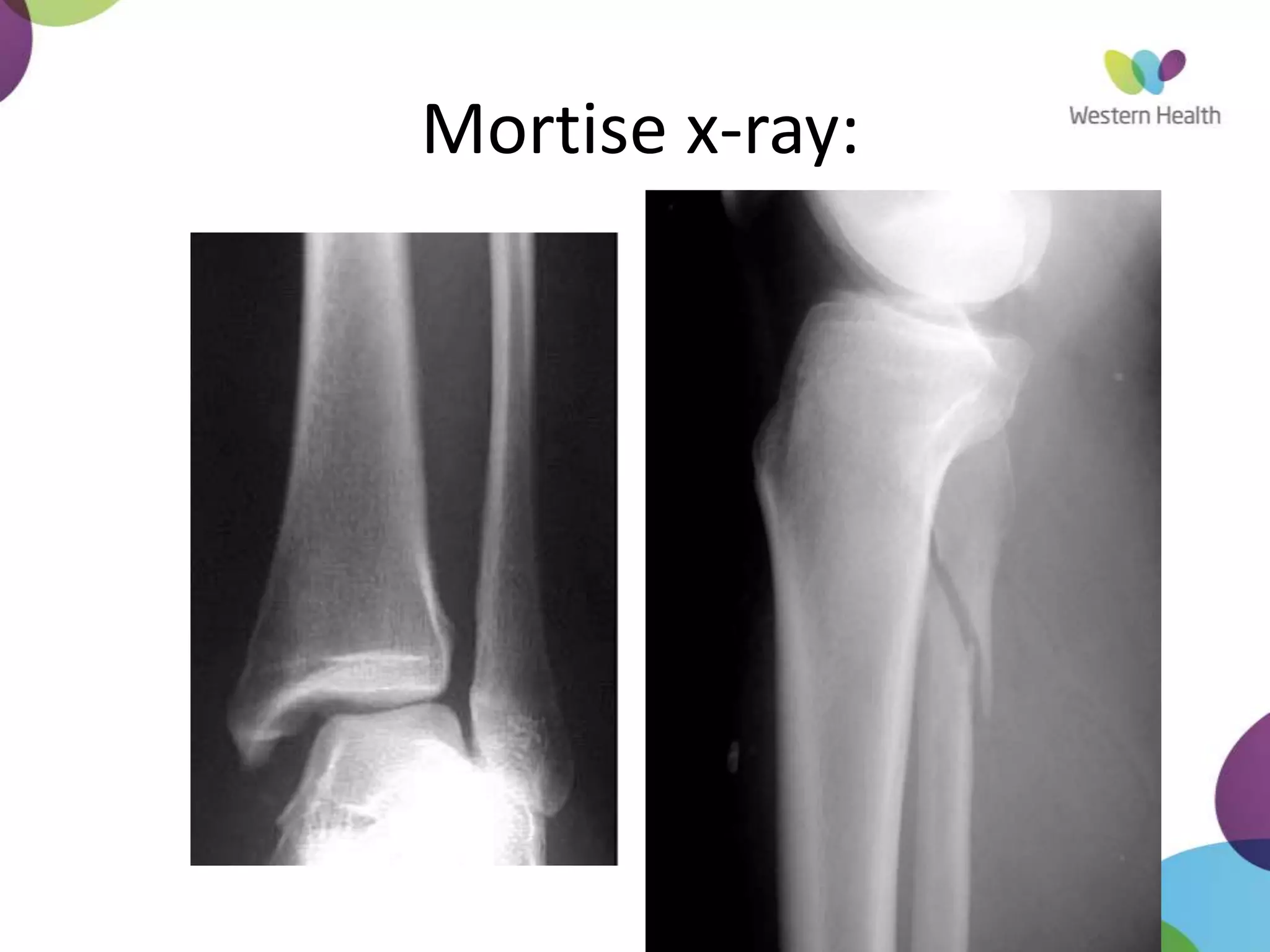 Mortise x-ray:
 