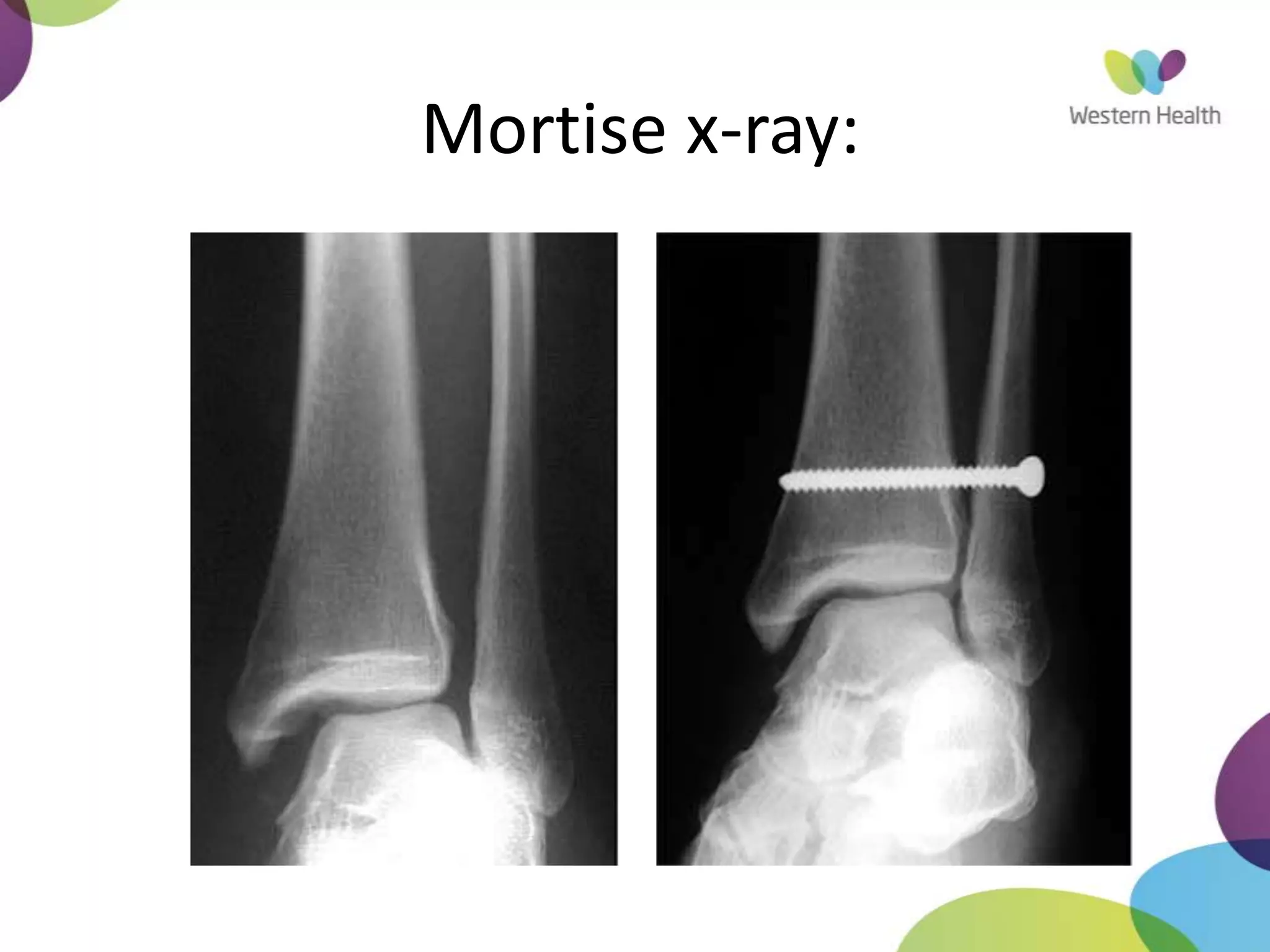 Mortise x-ray:
 