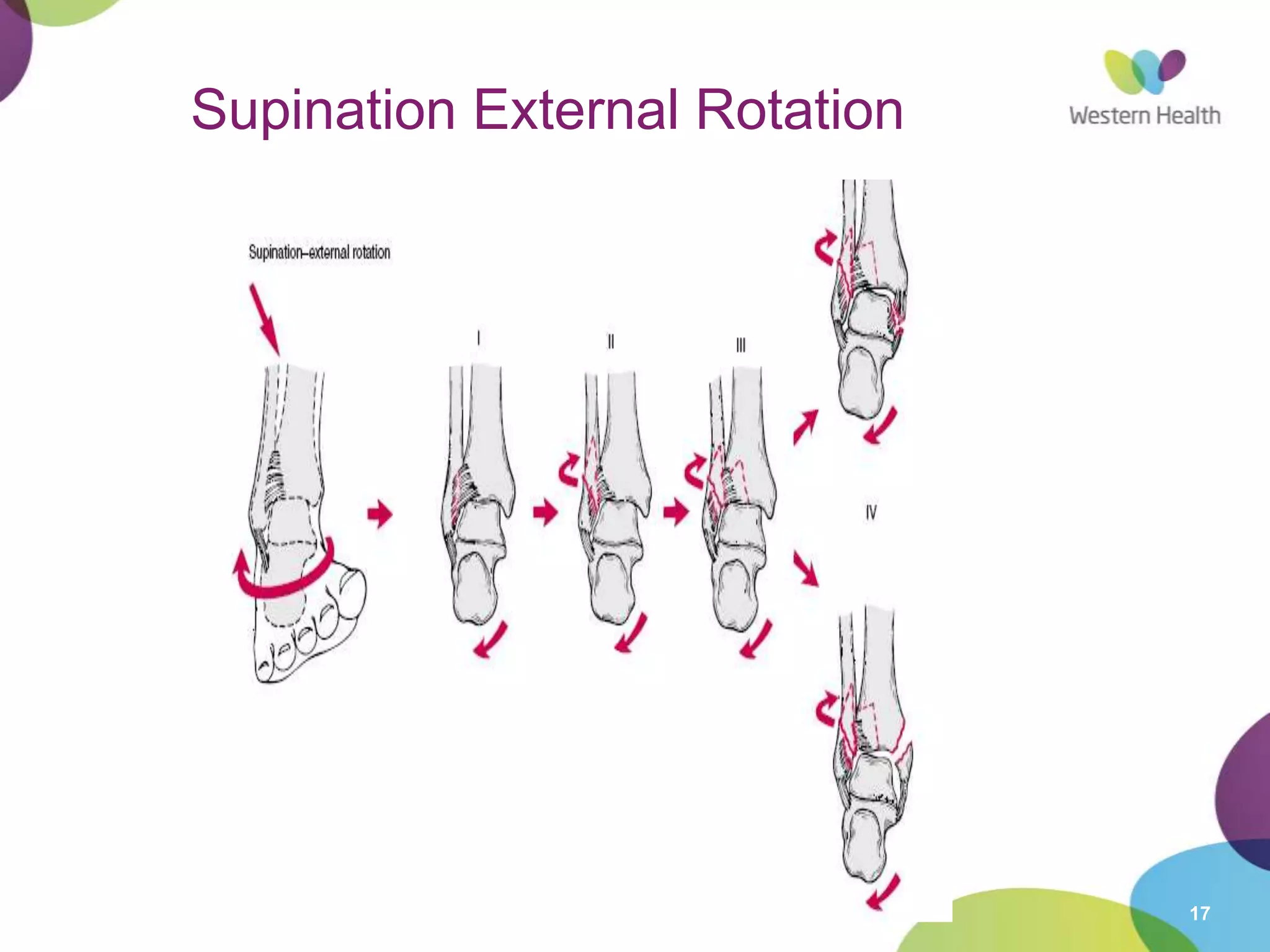 17
Supination External Rotation
 