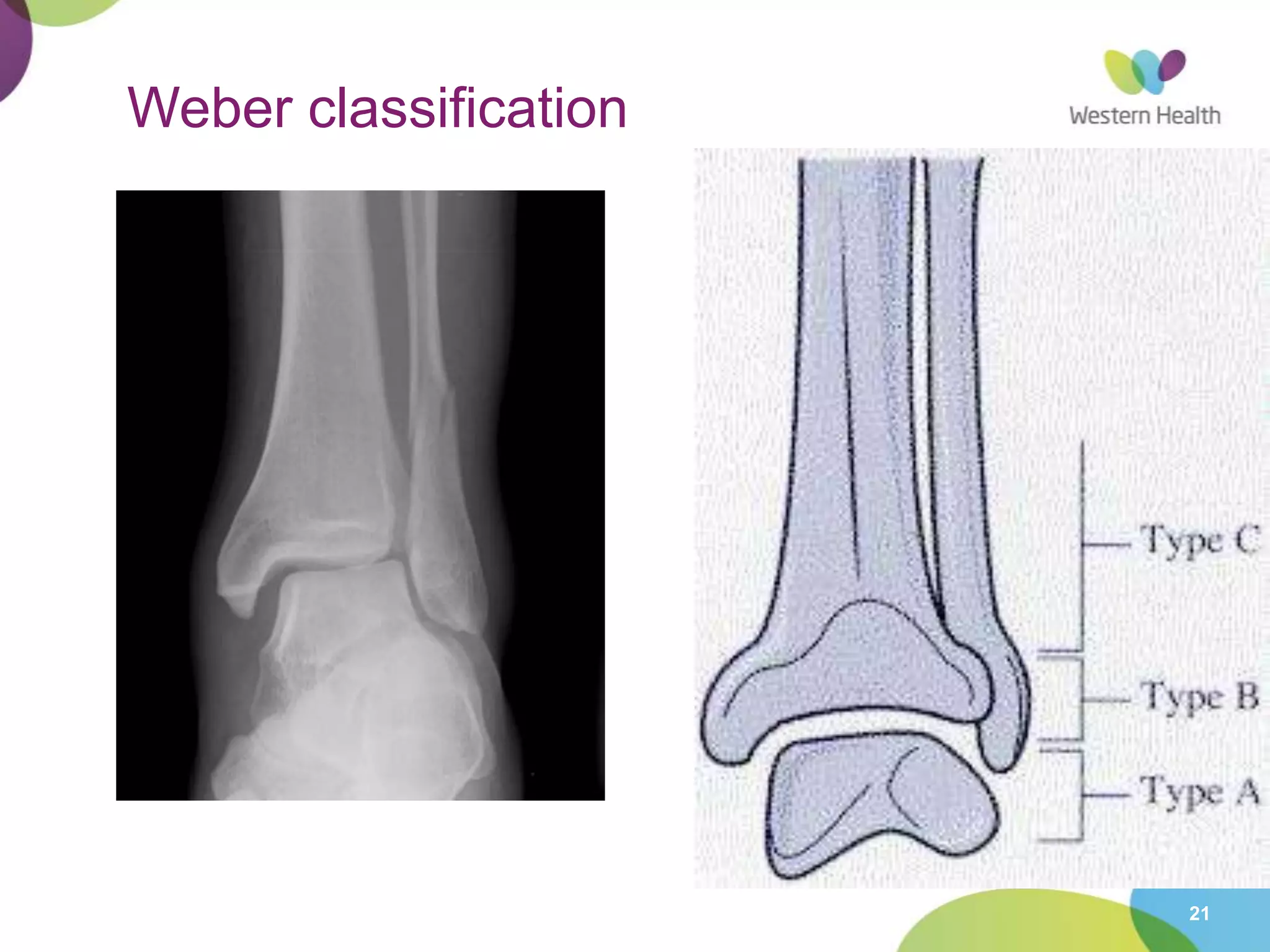 21
Weber classification
 