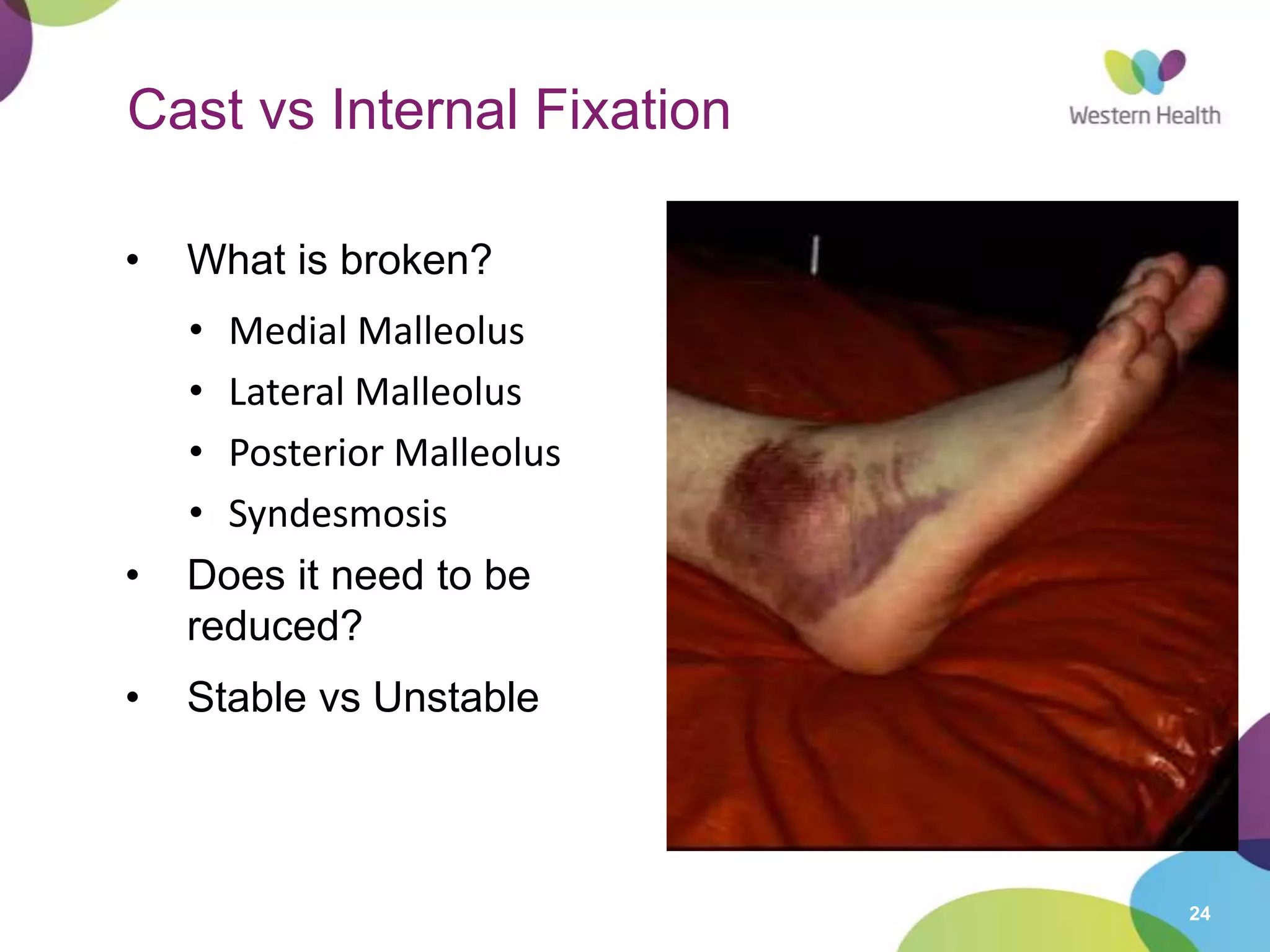 24
Cast vs Internal Fixation
• What is broken?
• Medial Malleolus
• Lateral Malleolus
• Posterior Malleolus
• Syndesmosis
• Does it need to be
reduced?
• Stable vs Unstable
 