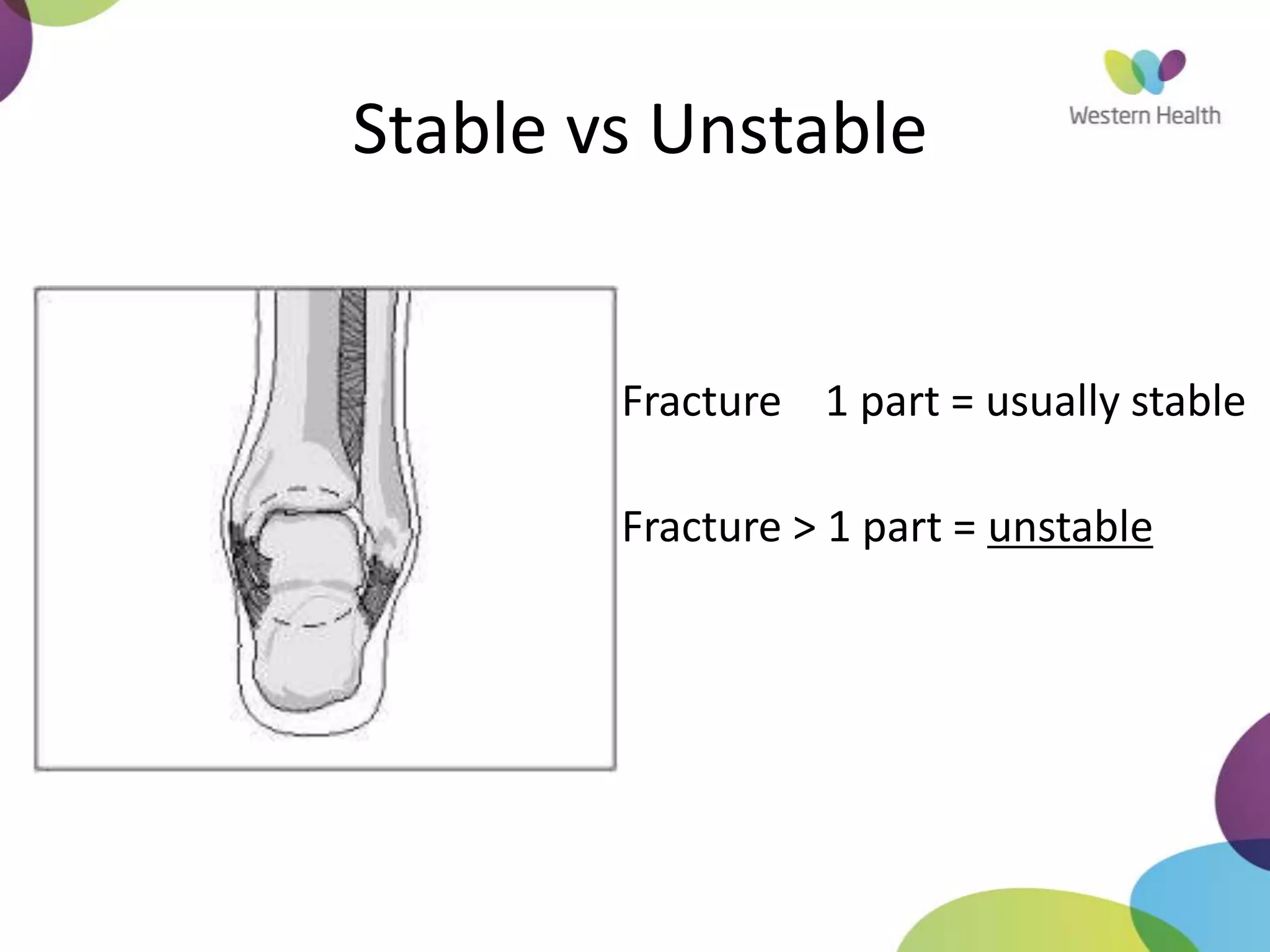 Stable vs Unstable
• Fracture 1 part = usually stable
• Fracture > 1 part = unstable
 