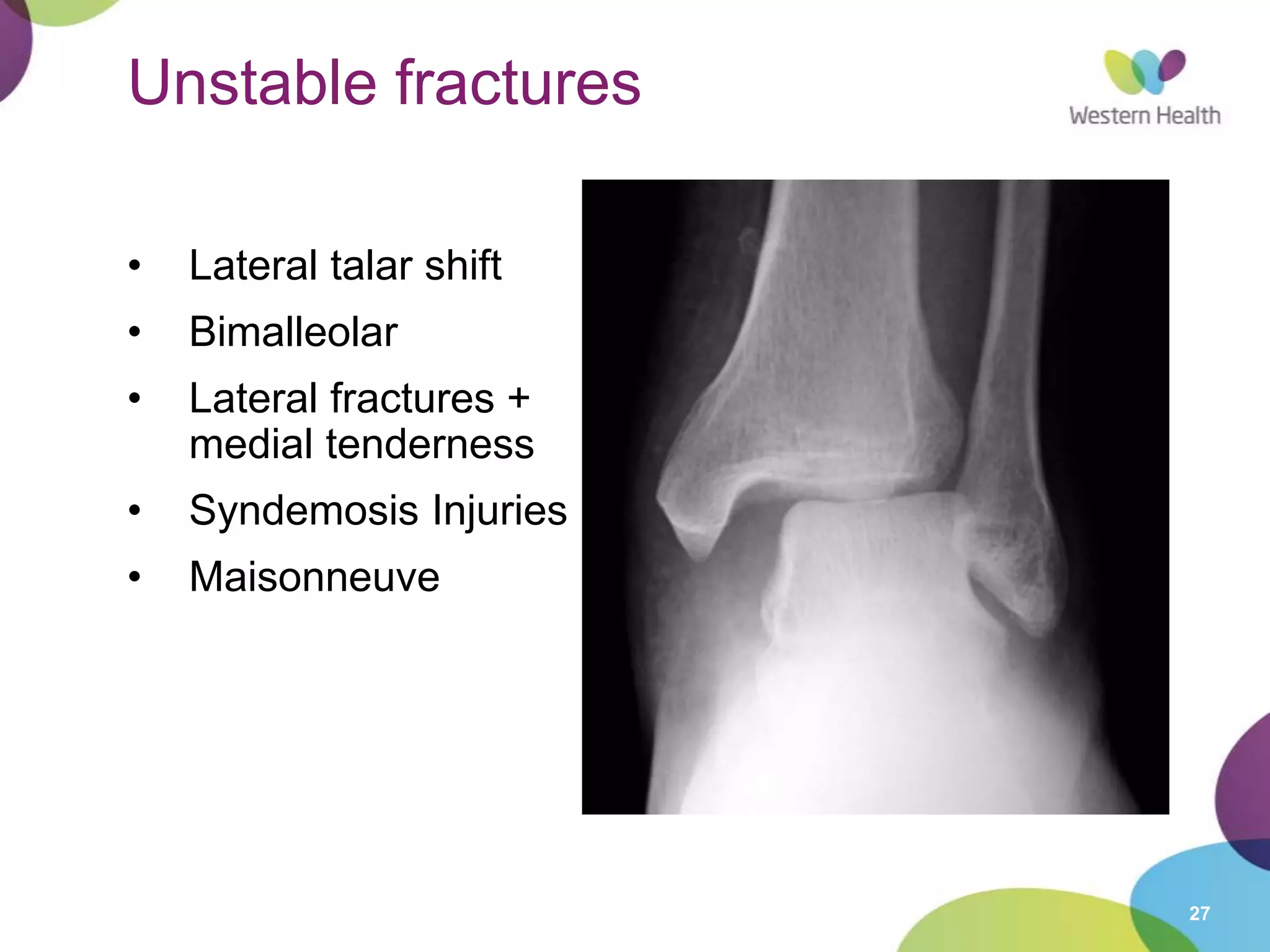 27
Unstable fractures
• Lateral talar shift
• Bimalleolar
• Lateral fractures +
medial tenderness
• Syndemosis Injuries
• Maisonneuve
 