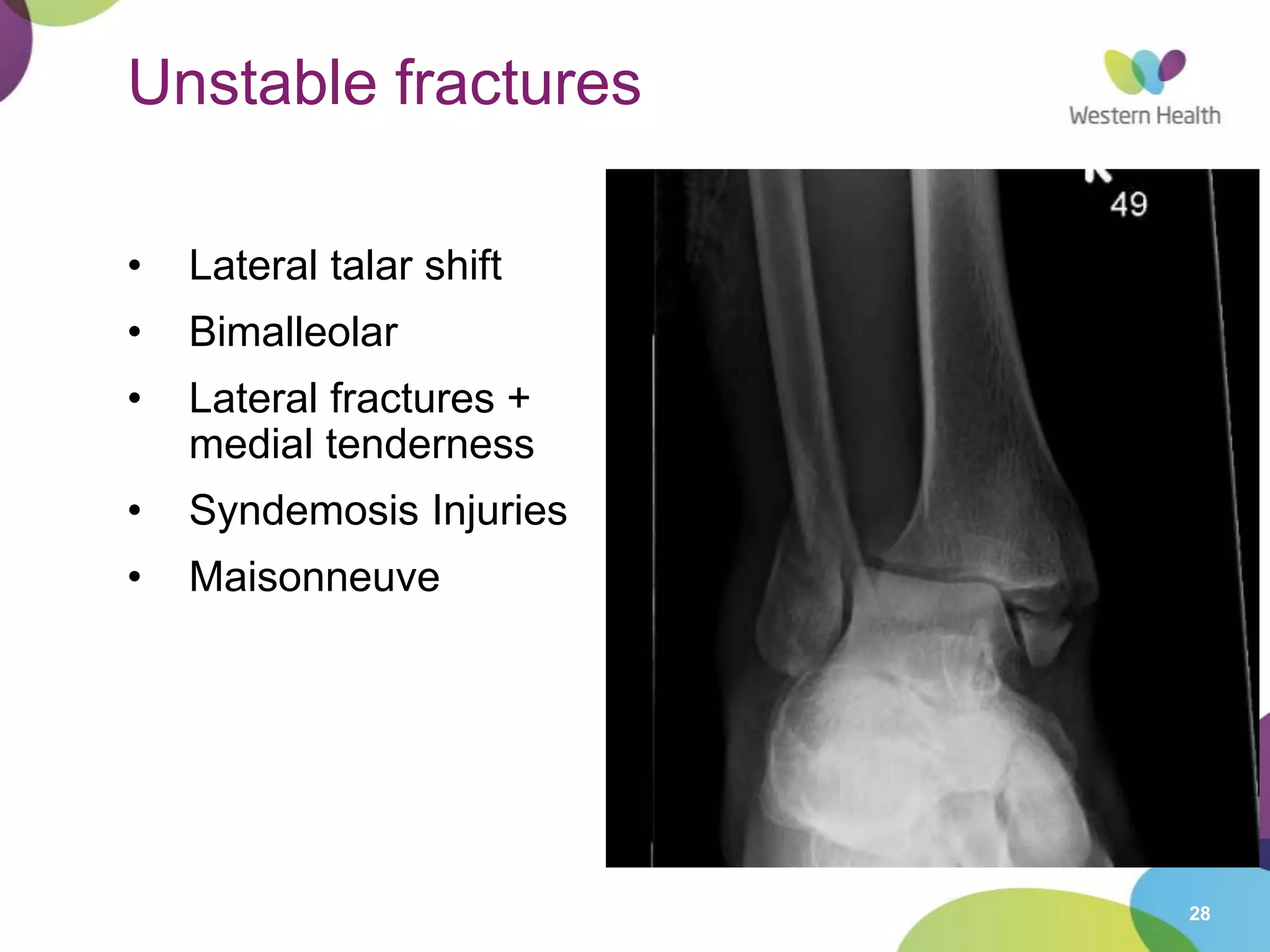 28
Unstable fractures
• Lateral talar shift
• Bimalleolar
• Lateral fractures +
medial tenderness
• Syndemosis Injuries
• Maisonneuve
 