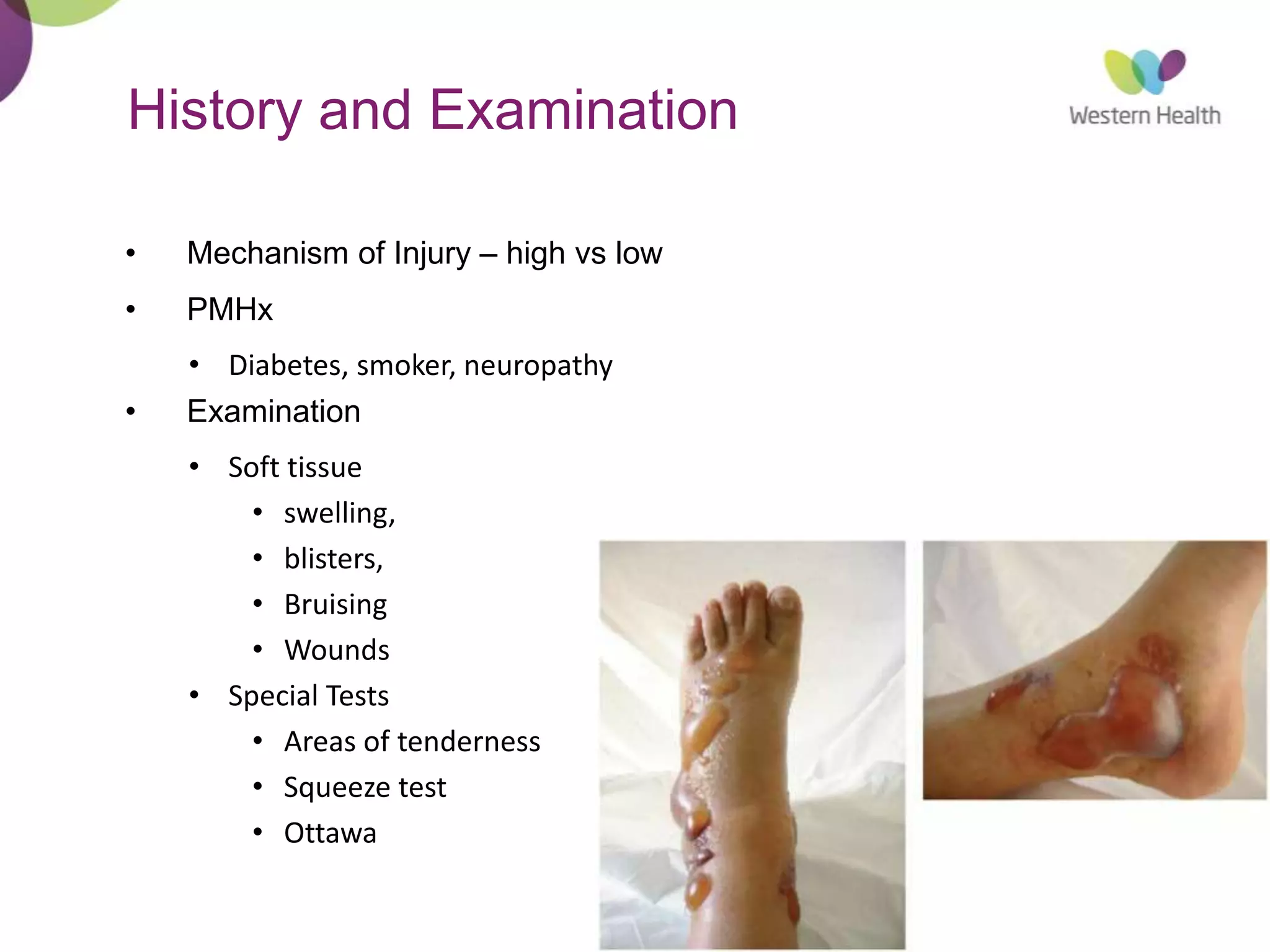 3
History and Examination
• Mechanism of Injury – high vs low
• PMHx
• Diabetes, smoker, neuropathy
• Examination
• Soft tissue
• swelling,
• blisters,
• Bruising
• Wounds
• Special Tests
• Areas of tenderness
• Squeeze test
• Ottawa
 