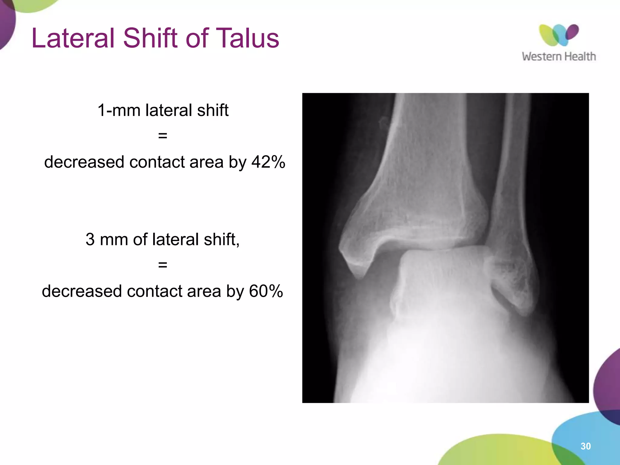 30
Lateral Shift of Talus
1-mm lateral shift
=
decreased contact area by 42%
3 mm of lateral shift,
=
decreased contact area by 60%
 