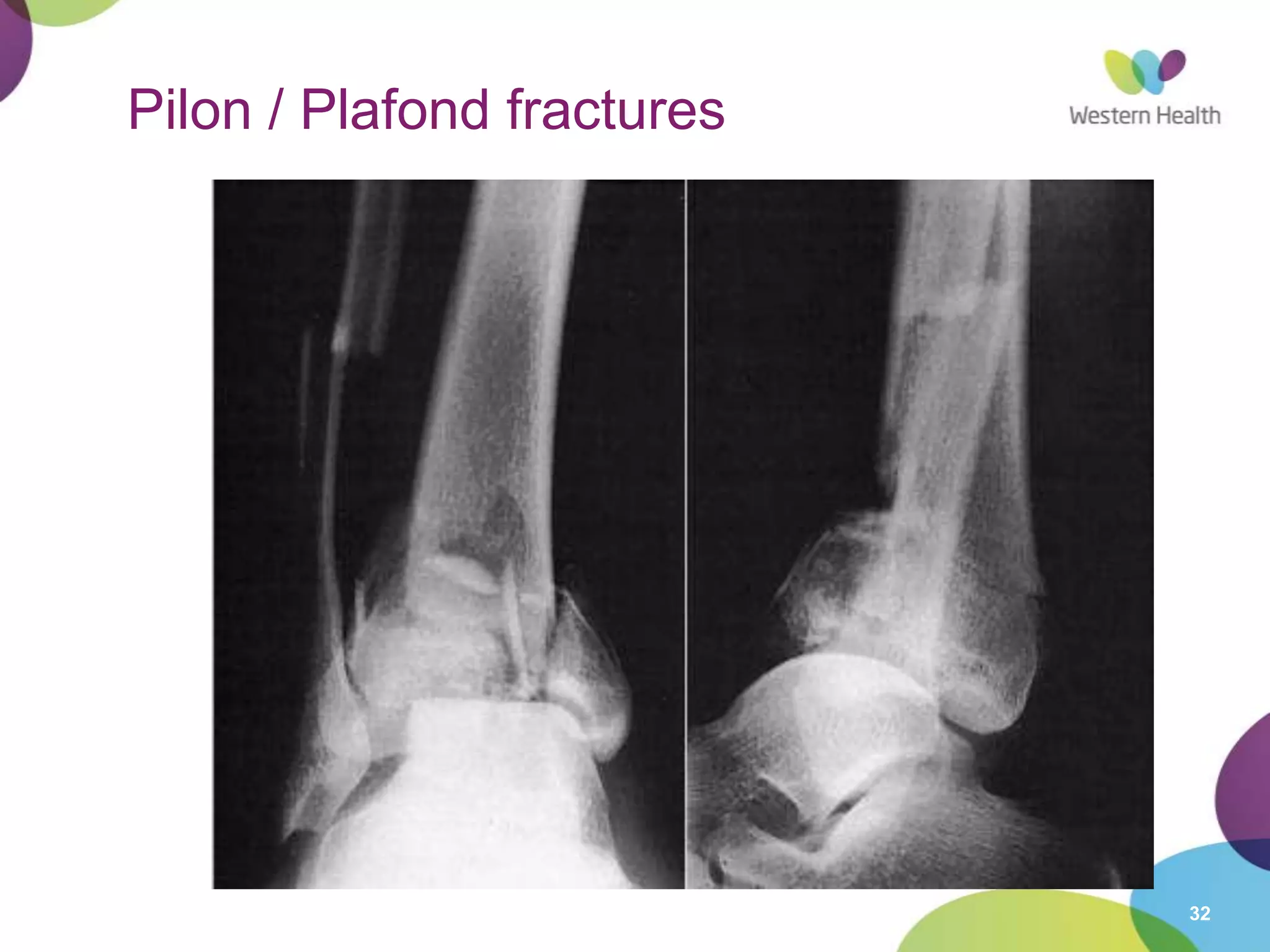 32
Pilon / Plafond fractures
 