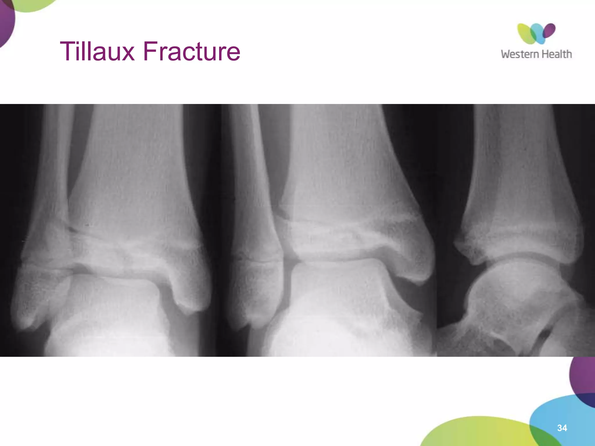 34
Tillaux Fracture
• Occurs in 12-14 year olds
18 month period when epiphysis is closing
• Salter-Harris 3 injury
Runs through anterolateral physis until reaches fused part, then
extends inferiorly through epiphysis into joint
Visible if x-ray parallel to plane of fracture (may require oblique)
• Mechanism
External rotation
Strenth of tibiofibular ligament > unfused epiphysis
 