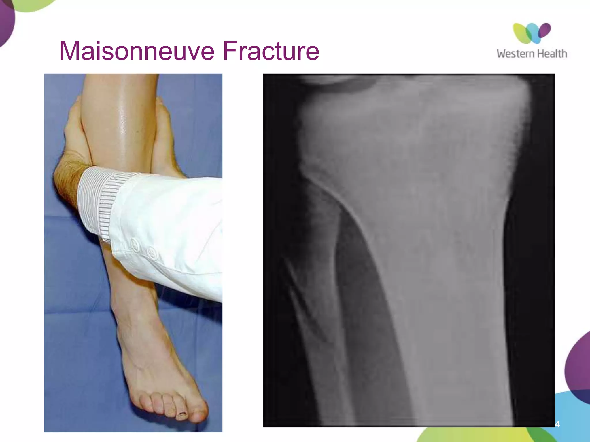 4
Maisonneuve Fracture
 