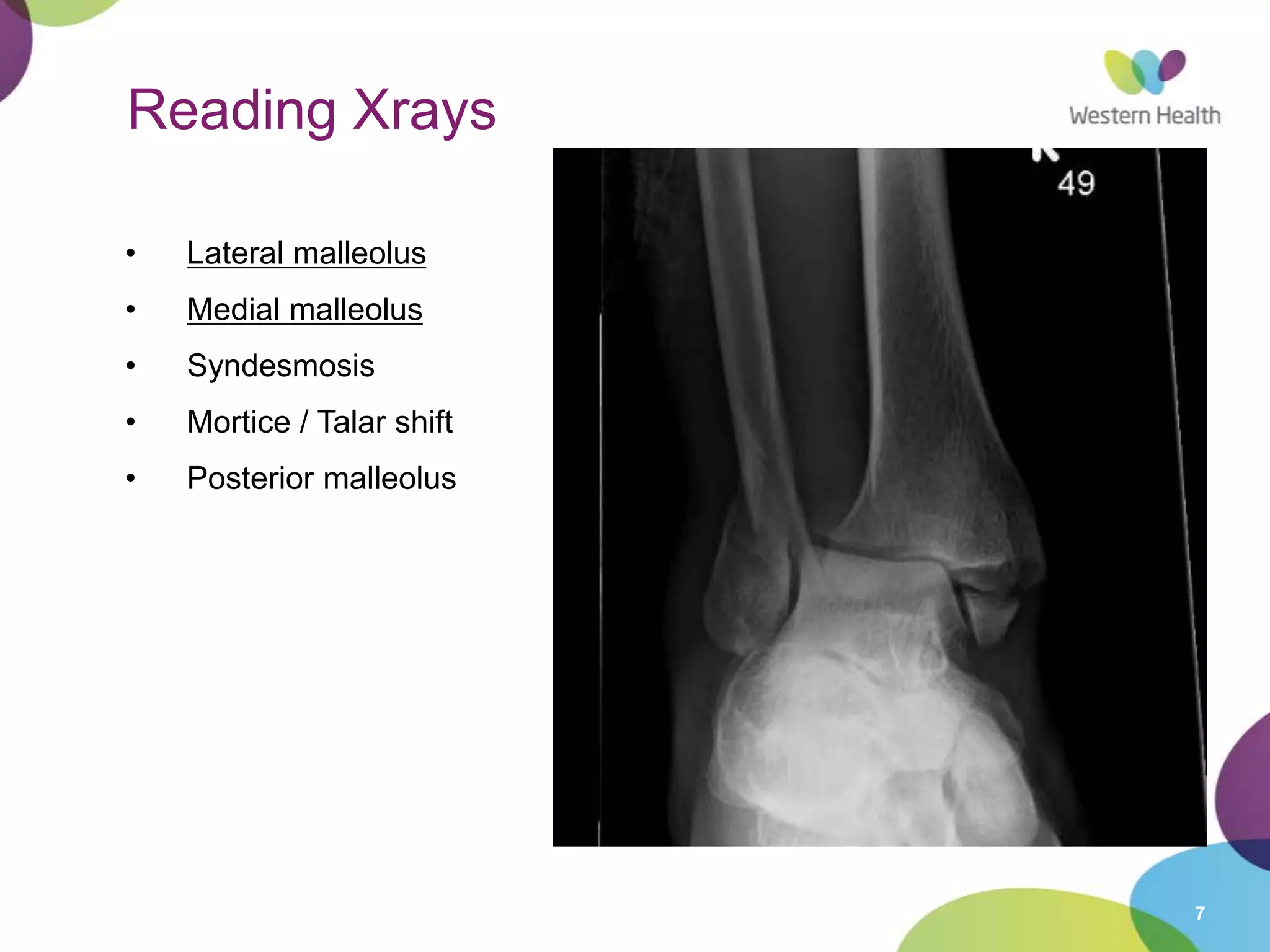 7
Reading Xrays
• Lateral malleolus
• Medial malleolus
• Syndesmosis
• Mortice / Talar shift
• Posterior malleolus
 