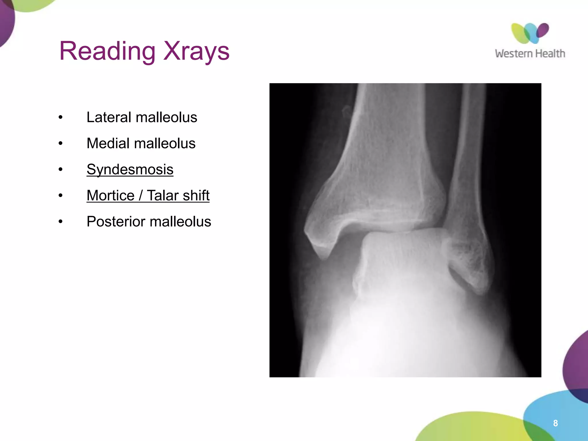 8
Reading Xrays
• Lateral malleolus
• Medial malleolus
• Syndesmosis
• Mortice / Talar shift
• Posterior malleolus
 