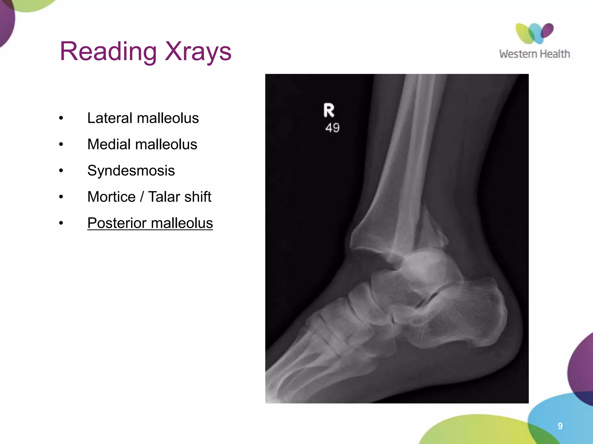 9
Reading Xrays
• Lateral malleolus
• Medial malleolus
• Syndesmosis
• Mortice / Talar shift
• Posterior malleolus
 
