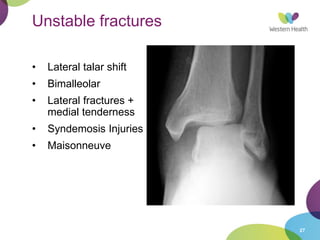 Ankle Fractures.ppt