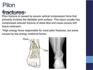 anklefractures.pptxnsnsnsndndndjdnndndjdjdjd | PPTX