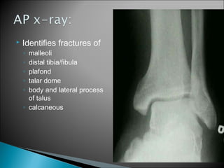  Identifies fractures of
◦ malleoli
◦ distal tibia/fibula
◦ plafond
◦ talar dome
◦ body and lateral process
of talus
◦ calcaneous
 