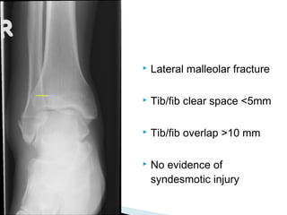  Lateral malleolar fracture
 Tib/fib clear space <5mm
 Tib/fib overlap >10 mm
 No evidence of
syndesmotic injury
 