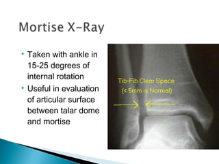  Taken with ankle in
15-25 degrees of
internal rotation
 Useful in evaluation
of articular surface
between talar dome
and mortise
 
